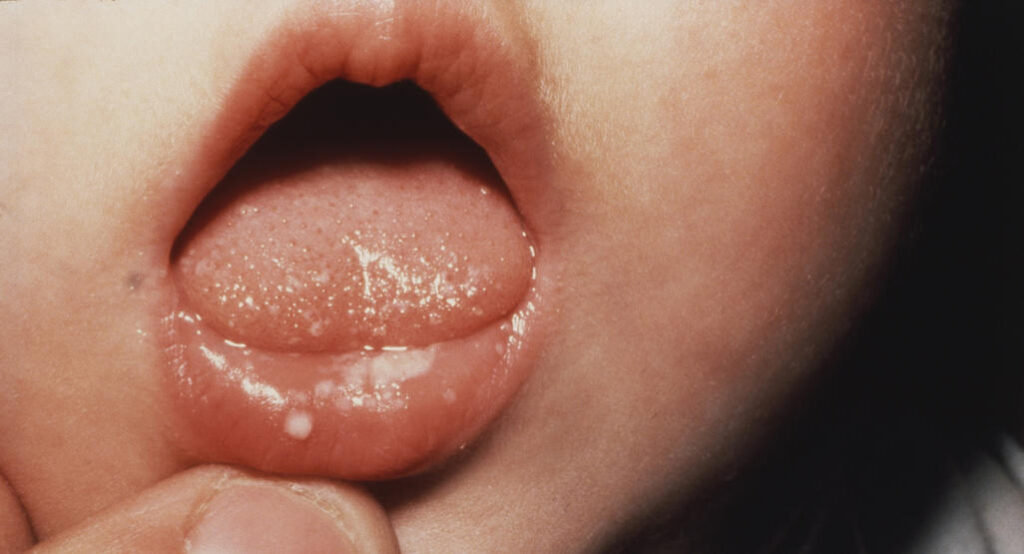 برفک دهان نوزاد چیست
